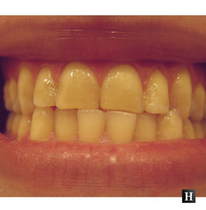 cauze ingalbenire dinti